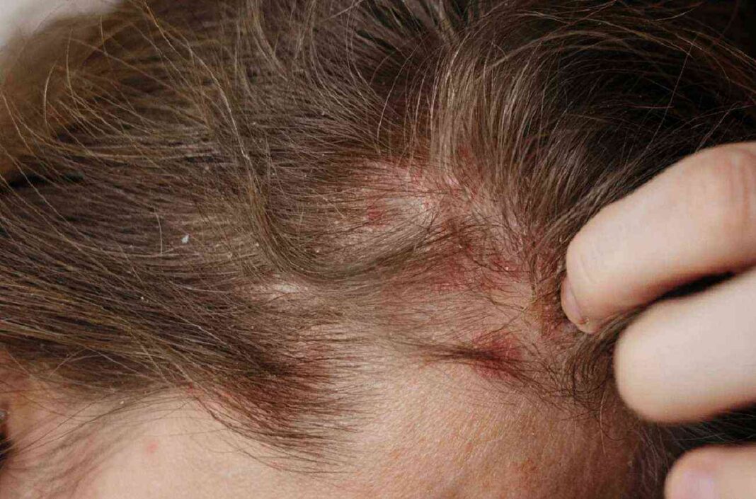 hair loss and eczema