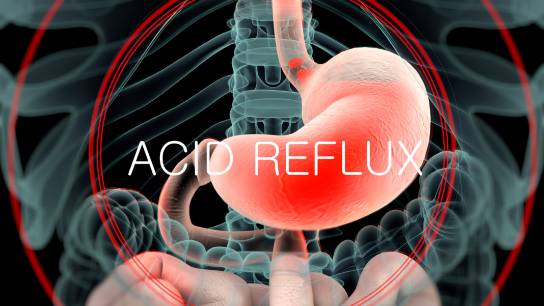 Acid Reflux Symptoms